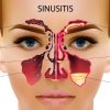 Sinusitis