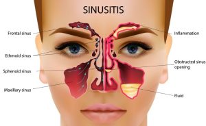 Sinusitis